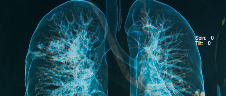 Embolismo pulmonar agudo